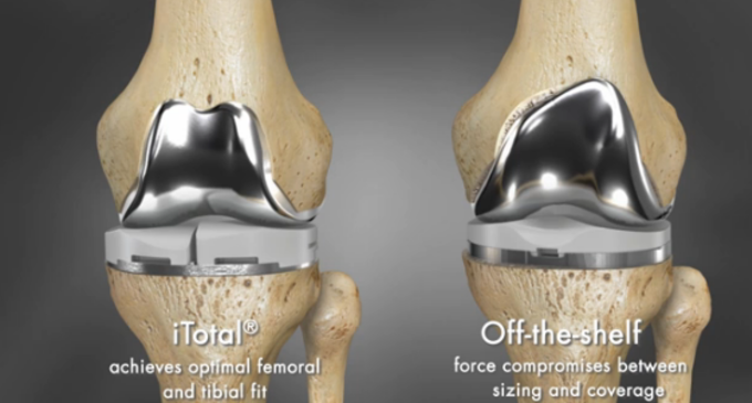 Article_knee-implant-3d-printing-1