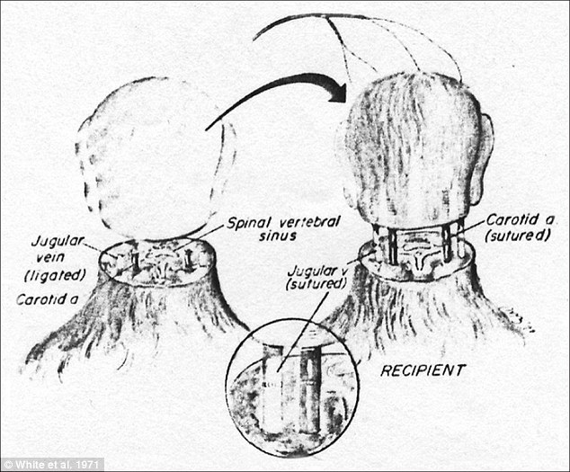 History: In 1970 Dr Robert White transplanted the head of one monkey onto the body of another, as shown in this diagram. If Mr Spiridonov's head were to be successfully transplanted his jugular vein and spinal cords would have to be similarly fused with those of his new donor body